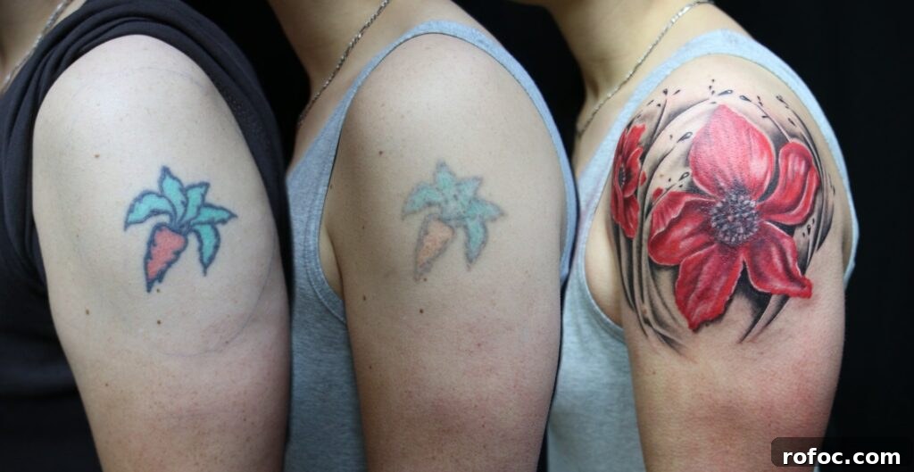 Tattoo removal